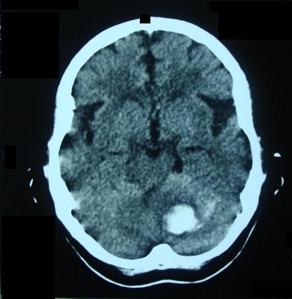 An axial non-contrast computed tomography (CT) scan of the brain demonstrating an acute hypertensive intracranial hemorrhage. A prominent, well-circumscribed hyperdense (bright) lesion is visible in the left deep cerebellar hemisphere, specifically involving the region of the dentate nuclei. The lack of surrounding hypodense vasogenic edema suggests a very acute onset, approximately within a few hours of the scan. In the contralateral (right) cerebellar hemisphere, there is a subtle area of decreased density/slit-like space indicating a resolved previous hematoma. The supratentorial structures, including the ventricles and cortical sulci, appear relatively normal in size and configuration for the patient's age. This image is clinically significant for demonstrating recurrent spontaneous intraparenchymal hemorrhage in a patient with hypertension, highlighting the typical locations and the appearance of acute versus chronic blood products on CT.