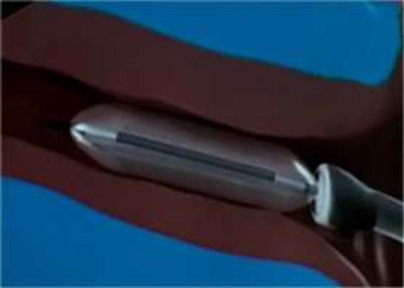 This anatomical diagram and medical illustration depicts the cartilaginous portion of the human Eustachian tube during a balloon tuboplasty procedure. A metallic, silver-colored cylindrical balloon catheter with a tapered tip and a dark longitudinal marker is shown positioned within the tubular lumen. The surrounding cartilaginous walls are rendered in a deep reddish-brown, appearing dilated to accommodate the inflated device. The image demonstrates the procedural mechanism for treating Eustachian tube dysfunction, where high-pressure inflation (typically 10 bars) is used to mechanically widen the nasopharyngeal orifice and cartilaginous canal. This educational visual is intended for Otolaryngology (ENT) trainees to understand the minimally invasive approach of balloon eustachian tuboplasty (BET) and the spatial relationship between the catheter and the anatomical landmarks of the parapharyngeal space.