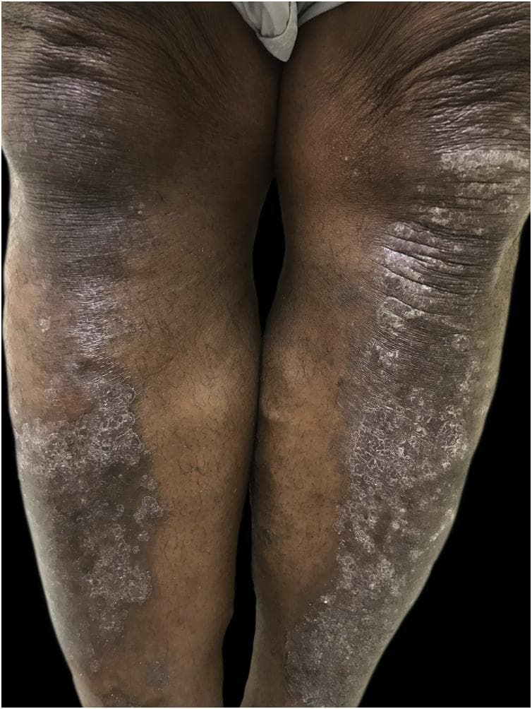 Clinical photograph of the anterior surface of the bilateral lower extremities in a dark-skinned patient, demonstrating chronic plaque psoriasis. The image shows extensive, well-demarcated hyperchromic plaques concentrated over the pretibial regions and knees. These plaques are characterized by thick, micaceous, silvery-white scales that contrast sharply with the dark, hyperpigmented base of the skin. There is evidence of lichenification, with prominent skin markings and a thickened, rough texture within the affected areas, suggesting chronic inflammation and mechanical friction. The presentation highlights the clinical appearance of psoriasis in skin of color, where erythema is often masked by hyperpigmentation and scaling may appear more prominent. The symmetrical distribution over the extensor surfaces is characteristic of the disease. This image serves as an educational resource for identifying dermatological manifestations in highly pigmented skin and understanding the morphological features of moderate-to-severe plaque psoriasis.