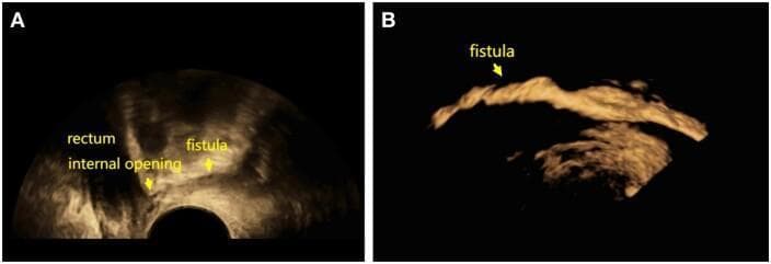 This diagnostic image provides a side-by-side comparison of 3D transperineal ultrasound (3D-TPUS) findings in the evaluation of a fistula-in-ano. Image A demonstrates a standard unenhanced ultrasound view where the rectum is identified, and the anal fistula appears as a subtle, linear hypoechoic tract extending towards an internal opening. Image B shows the same anatomical region after the administration of SonoVue (SVE) contrast. The contrast-enhanced ultrasound (CEUS) technique causes the fistulous tract to become markedly hyperechoic and lustrously reflective, clearly delineating the pathway and branching of the fistula against the dark background. The images illustrate the clinical utility of contrast-enhanced 3D imaging in improving the visibility and diagnostic accuracy of complex perianal fistulae and their internal openings. This educational material is relevant for proctology and radiology specialties, focusing on advanced imaging modalities for perianal disease assessment.