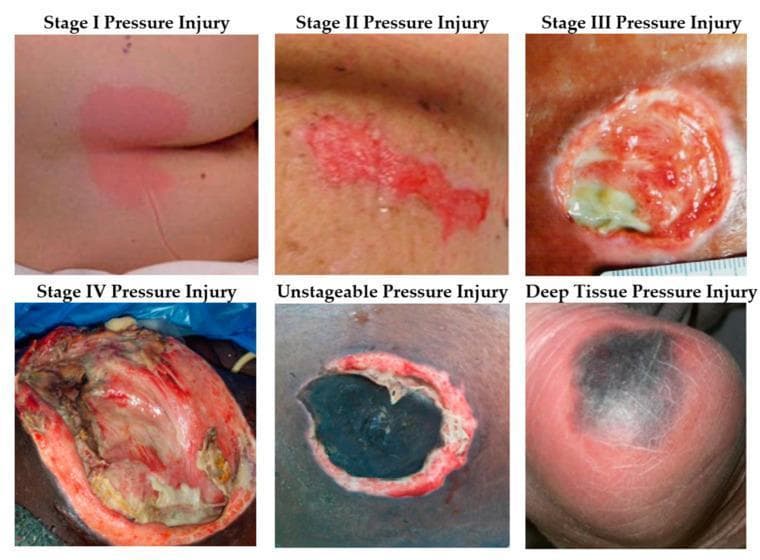 This clinical photographic comparison illustrates the diverse visual presentations of pressure injuries (decubitus ulcers) according to the National Pressure Injury Advisory Panel (NPIAP) staging system. The image is organized into a six-panel grid. Stage I: Shows intact skin with localized non-blanchable erythema. Stage II: Displays partial-thickness skin loss with a shallow, open ulcer and a red-pink wound bed. Stage III: Exhibits full-thickness skin loss where subcutaneous fat is visible within a deeper, crater-like wound. Stage IV: Demonstrates extensive full-thickness tissue loss with exposed muscle, tendon, or fascia. The Unstageable Pressure Injury panel shows a wound bed completely obscured by dark eschar or yellow slough, preventing depth assessment. The Deep Tissue Pressure Injury (DTPI) panel presents as a localized area of intact skin with deep purple or maroon discoloration, indicating underlying soft tissue damage. This educational resource is intended for dermatology and nursing students to assist in the clinical classification, wound assessment, and management of pressure-related skin lesions.