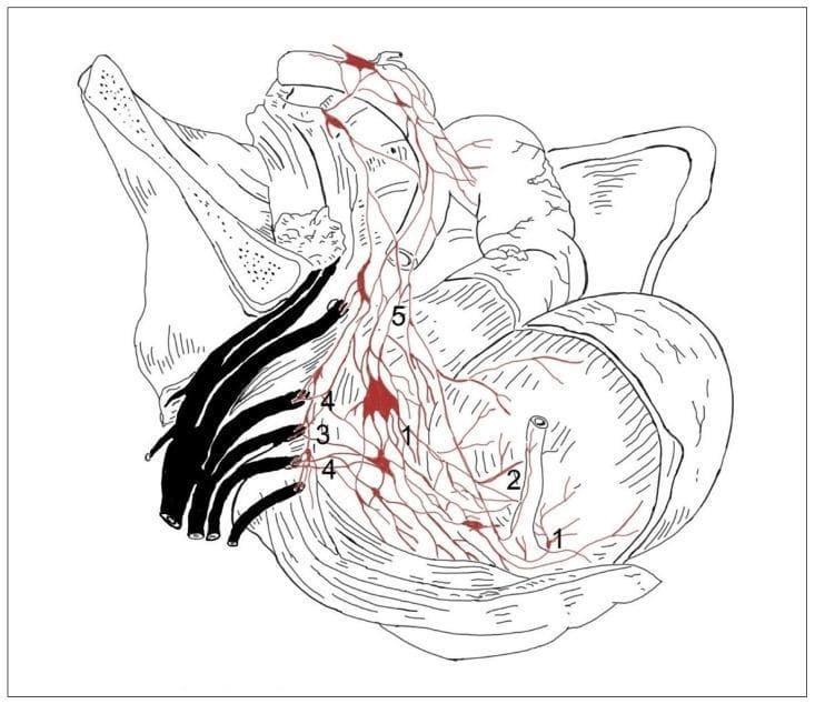 This medical anatomical diagram illustrates the autonomic nerve supply to the human pelvic viscera, specifically demonstrating the 'concentrated type' of innervation pattern. The illustration depicts a lateral view of the pelvic cavity with the rectum (1) and urinary bladder (2) as primary targets of innervation. Key structures include the sacral sympathetic trunk (3), shown as prominent vertical dark cords, and the nervi erigentes (4) or pelvic splanchnic nerves arising from the sacral plexus. The inferior hypogastric plexus (5) is shown as a network of nerves and ganglia (red highlights) distributing to the bladder and rectum. This concentrated variation is characterized by a simplified neural architecture: fewer, larger ganglia and less frequent, weaker connections between the sympathetic trunk and the visceral plexuses compared to the segmental type. The diagram is intended for neuroanatomical education, highlighting variations in pelvic autonomic pathways relevant to surgical considerations in proctology and urology.