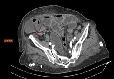 This axial contrast-enhanced CT scan of the pelvis demonstrates a Spigelian hernia on the right side. The image shows a hernia sac containing a loop of small bowel and omental fat protruding through a defect in the abdominal wall. A key finding is the 'double beak' sign at the hernial neck (indicated by a red arrow), where two transition zones of the incarcerated bowel loop converge at the narrow 13 mm fascial defect. The wall of the incarcerated bowel loop shows a lack of significant intravenous contrast enhancement compared to adjacent healthy bowel, a radiological sign highly suggestive of bowel wall ischemia and potential necrosis. Proximally, there is evidence of bowel obstruction with dilated small bowel loops, while the distal colon appears collapsed. This imaging is used in medical education to illustrate the diagnostic features of strangulated abdominal wall hernias and the importance of evaluating bowel wall enhancement in emergency surgical scenarios.