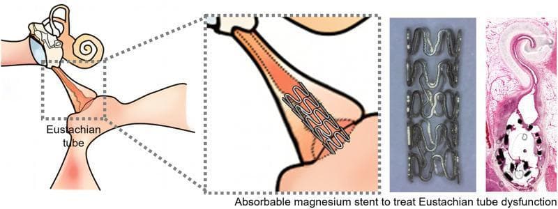 A multi-panel educational graphic illustrating the use of an absorbable magnesium (Mg) stent for managing Eustachian tube dysfunction (ETD). The leftmost section is an anatomical schematic of the ear and nasopharynx, highlighting the Eustachian tube (ET) with a dotted box. A magnified inset shows the stent positioned within the ET lumen, distal to the middle ear space, maintaining patency. The third panel features a high-resolution photograph of the standalone magnesium stent, revealing a metallic, cylindrical lattice structure composed of interconnected sinusoidal or wave-like struts. The final panel is a histological cross-section (H&E stain) of the ET lumen containing the stent, demonstrating the relationship between the stent struts and the surrounding submucosal tissue. The visual material focuses on the clinical application of biodegradable materials in otolaryngology to prevent stent-induced tissue hyperplasia while providing temporary mechanical support to the Eustachian tube.