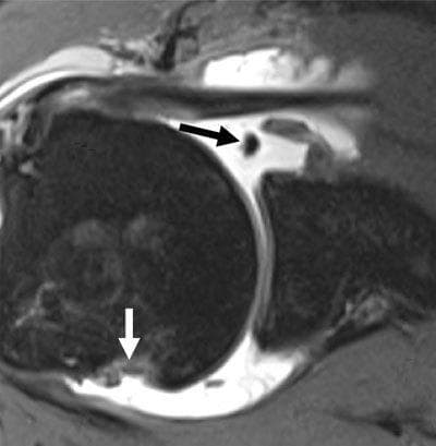 This diagnostic image is an axial MR arthrogram of the shoulder joint, highlighting the glenohumeral anatomy in a patient with chronic antero-inferior instability. The image demonstrates two hallmark findings of anterior shoulder dislocation. First, a soft-tissue Bankart lesion is visible at the antero-inferior aspect of the glenoid (indicated by a black arrow), characterized by the detachment of the fibrocartilaginous labrum from the glenoid rim with a concurrent tear of the glenoid periosteum. Second, a Hill-Sachs lesion is present (indicated by a white arrow) as an impaction fracture at the postero-superior aspect of the humeral head. Intra-articular contrast material fills the joint space, accentuating the discontinuity between the labrum and the glenoid bone. This image is a key educational resource for orthopedic radiology, illustrating the common sequelae of shoulder dislocation and the importance of identifying both soft tissue and bony defects that contribute to joint instability.