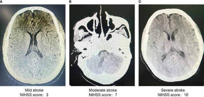 This diagnostic imaging set consists of three non-contrast axial computed tomography (CT) scans of the head, demonstrating various presentations of ischemic stroke categorized by National Institutes of Health Stroke Scale (NIHSS) severity. Panel A represents a mild stroke (NIHSS: 3), showing relatively preserved gray-white matter differentiation and symmetrical lateral ventricles with no visible acute hypodensity or mass effect. Panel B depicts a moderate stroke (NIHSS: 7) at a lower anatomical level (base of skull/posterior fossa), showing early signs of subtle parenchymal hypoattenuation. Panel C illustrates a severe stroke (NIHSS: 16), characterized by significant loss of structural clarity, generalized loss of sulcal definition, and widespread areas of reduced tissue density (hypodensity), indicative of extensive cytotoxic edema and tissue damage. The series serves as an educational comparison of radiological findings—such as loss of gray-white matter ribbon and ventricular compression—correlated with clinical neurological deficits in acute cerebrovascular accidents.