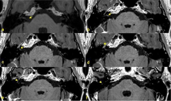 A series of six axial magnetic resonance imaging (MRI) scans using 3D T1-weighted Fast Spin Echo (FSE) sequences, labeled (a) through (f). The images provide high-resolution views of the posterior cranial fossa at the level of the pons and the petrous part of the temporal bone. Yellow arrows specifically point to the various anatomical segments of the facial nerve (Cranial Nerve VII) to illustrate its course and signal intensity characteristics. The segments identified include: (a) medial canalicular and (b) fundal canalicular portions within the internal auditory canal (IAC); (c) the labyrinthine segment; (d) the geniculate ganglion at the first genu; (e) the tympanic (horizontal) segment; and (f) the mastoid (vertical) segment. These diagnostic images are used for neuroradiological assessment of nerve morphology and pre-gadolinium signal baseline. Key anatomical landmarks visible include the brainstem (pons), cerebellum, and the bony labyrinth of the inner ear, which presents with low signal (dark) on these T1-weighted views compared to the intermediate signal of the brain parenchyma.