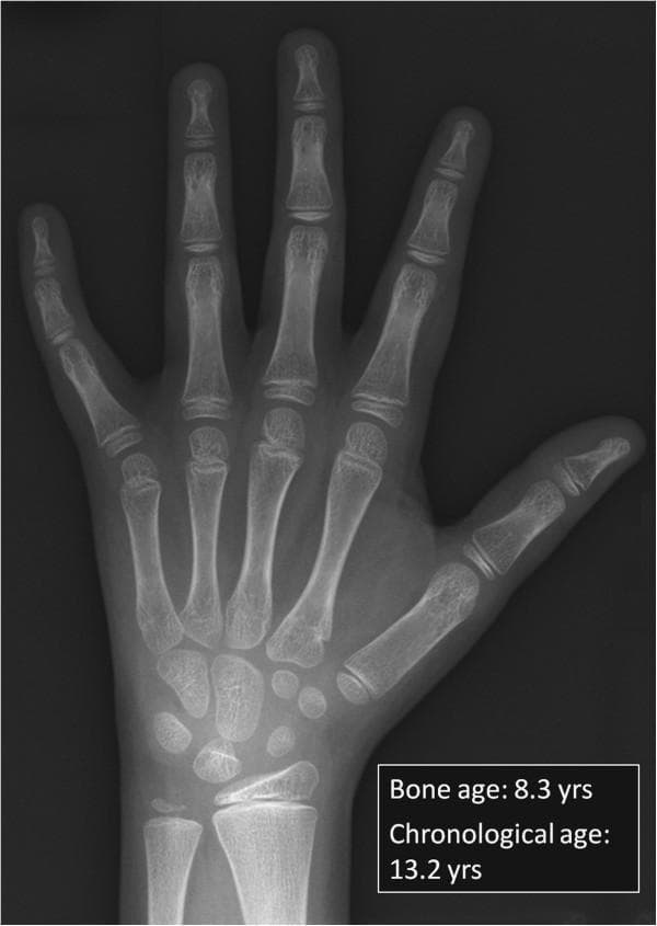 This diagnostic image is a posterior-anterior (PA) X-ray of the left hand and wrist, primarily used for bone age assessment. The radiograph reveals significant constitutional growth delay. Although the patient's chronological age is 13.2 years, the skeletal development corresponds to a bone age of approximately 8.3 years. Key visual findings include the presence of multiple carpal ossification centers that are small and rounded, lacking the mature morphology and fusion expected for an early adolescent. The metacarpals and phalanges exhibit wide, radiolucent growth plates (physeal lines), with distinct epiphyses that are not yet fused to the metaphyses. The ulnar styloid and distal radial epiphysis are also underdeveloped relative to the chronological age. This clinical photograph demonstrates delayed skeletal maturation, a common feature in conditions like Barth syndrome or other constitutional growth delays, serving as a pedagogical tool for understanding the discrepancy between chronological and biological age in pediatric endocrinology and metabolic disorders.