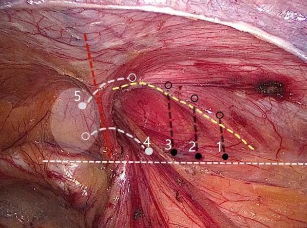 This clinical photograph shows a laparoscopic view of the inguinal region during an internal ring closure procedure, specifically demonstrating a 'five-stitches method' for hernia repair. The surgical field displays the reddish-pink fibrous texture of the conjoined tendon and the iliopubic tract, with prominent epigastric vessels visible. Overlaid on the anatomy are numbered markers (1-5) and colored dashed lines illustrating the suturing technique: black solid dots indicate needle entry points, while open circles represent extraction points. Points 1-3 follow a lateral-to-medial linear path along the iliopubic tract, connected by a dashed yellow line. Points 4 and 5 transition into a U-shaped configuration, marked by a red dashed line, to navigate around the epigastric vessels. A white dashed line indicates the alignment of tissues for approximation. The diagram highlights the clinical strategy of superficial, small-bite suturing intended to avoid underlying neurovascular structures, including the iliac artery and branches of the genitofemoral and ilioinguinal nerves.