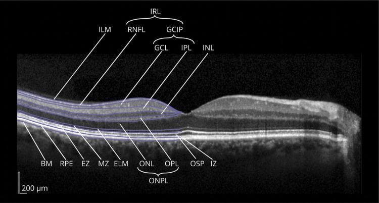 This diagnostic image is a central horizontal spectral-domain optical coherence tomography (SD-OCT) scan of the human retina, specifically centered on the fovea. It serves as a pedagogical tool for consensus nomenclature of retinal layers. The scan displays a cross-sectional view with labeled individual layers from inner to outer: Inner Limiting Membrane (ILM), Retinal Nerve Fiber Layer (RNFL), Ganglion Cell Layer (GCL), Inner Plexiform Layer (IPL), Inner Nuclear Layer (INL), Outer Plexiform Layer (OPL), Outer Nuclear Layer (ONL), External Limiting Membrane (ELM), Myoid Zone (MZ), Ellipsoid Zone (EZ), Outer Segment of Photoreceptors (OSP), Interdigitation Zone (IZ), Retinal Pigment Epithelium (RPE), and Bruch Membrane (BM). Labeled compound layers include the Inner Retinal Layers (IRL), Ganglion Cell and Inner Plexiform layer (GCIP), and Outer Nuclear and Plexiform Layer (ONPL). The foveal depression is clearly visible, showing characteristic thinning of the IRL and GCIP. This visual is intended for ophthalmology and neuro-ophthalmology education to define standard anatomical landmarks and boundaries in retinal imaging.