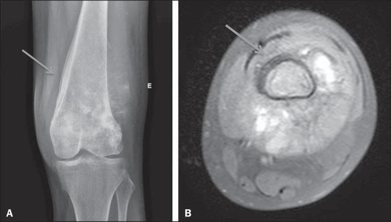 This composite diagnostic image demonstrates an aggressive periosteal reaction associated with osteosarcoma of the distal femur. Image A is a conventional radiograph (CR) of the knee in an anteroposterior view, showing a classic laminated, or 'onion skin,' periosteal reaction along the lateral aspect of the femoral diaphysis and metaphysis (arrow). This reaction is characterized by thin, concentric, radiopaque layers of new bone formation. Image B is an axial MRI scan of the same region, providing a cross-sectional view of the pathology. The MRI highlights the circumferential signal abnormalities at the periphery of the femoral cortex (arrow), corresponding to the laminated periosteal reaction and its extension into the adjacent soft tissues. The images illustrate key radiographic markers of aggressive bone lesions, emphasizing the high-velocity nature of the underlying disease process. These findings are clinically significant for the diagnosis of primary bone malignancies such as osteosarcoma or Ewing sarcoma, where rapid periosteal elevation occurs.