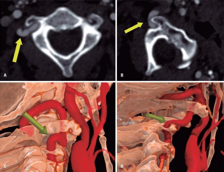 This composite diagnostic image illustrates dynamic vertebral artery compression, also known as Bow Hunter's Syndrome. Panels A and B are axial Computed Tomography Angiography (CTA) images. Panel A shows a dominant right vertebral artery in a neutral position with tortuosity at the V2 to V3 segment transition but maintained vessel caliber. Panel B, captured during contralateral head rotation, demonstrates severe focal stenosis of the same artery caused by mechanical compression between the superolateral aspect of the C2 transverse process and the adjacent bony structures. Panels C and D provide corresponding 3D volume-rendered reconstructions. Panel C shows the normal spatial relationship and vessel patency in a neutral state. Panel D highlights the dynamic narrowing and pinch effect on the vertebral artery during cervical rotation. The educational focus is on the radiological presentation of rotational vertebral artery occlusion and the utility of dynamic CTA in diagnosing vascular syndromes related to cervical spine anatomy.