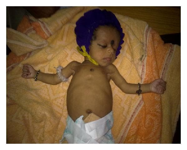 This clinical photograph shows a neonate in a supine position, documenting the clinical resolution of symptoms following treatment for congenital syphilis. The infant displays a significant improvement in spontaneous motor activity and posture compared to the initial presentation of Parrot's pseudoparalysis. The upper limbs are extended and abducted, showing no visible signs of the previously reported swelling in the elbow or knee joints. The skin is of normal color without evidence of rash, jaundice, or pallor. The infant appears calm with eyes closed, wearing a blue cap and a white diaper. Key clinical indicators illustrated here include the resolution of joint inflammation and the restoration of normal limb positioning and movement following antibiotic therapy (crystalline penicillin) for treponemal infection. The image serves as a post-treatment follow-up to confirm the efficacy of the management of neonatal syphilis.
