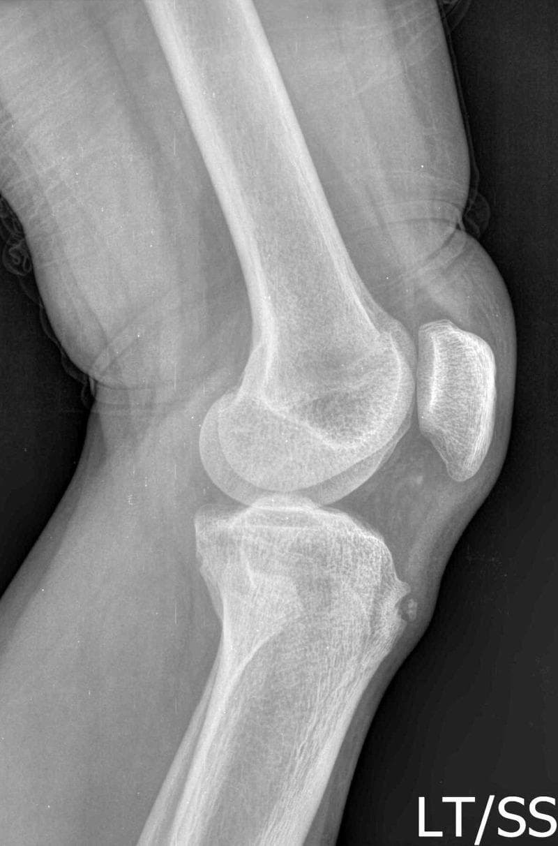 This diagnostic image is a lateral radiograph (X-ray) of the human knee joint, illustrating hallmark features of Osgood-Schlatter disease (OSD). The radiograph clearly depicts the distal femur, the patella, and the proximal tibia. The primary pathology is localized at the tibial tuberosity, where there is a visible bony prominence and irregularity. Notably, a small, distinct, separated ossicle is located anterior to the tibial tuberosity within the distal portion of the patellar tendon. These findings represent traction apophysitis or fragmentation of the tibial tubercle common in the sub-acute or chronic stages of OSD. The joint space appears preserved, and there is no evidence of acute fracture of the femoral condyles or the patella. This visual is significant for medical education in pediatrics and orthopedics for diagnosing adolescent knee pain and distinguishing traction apophysitis from acute avulsion fractures.
