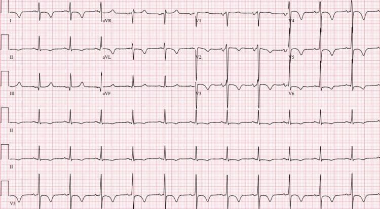 A standard 12-lead electrocardiogram (ECG) printed on red grid paper demonstrating significant repolarization abnormalities. The tracing shows a normal sinus rhythm with a prolonged corrected QT interval (QTc of 497 ms). Prominent pathological features include widespread ST-segment depression and deep, symmetric T-wave inversions. These changes are most pronounced in the anteroseptal leads (V1-V3) and the lateral leads (I, aVL, V4-V6). The inferior leads (II, III, aVF) also show subtle ST-segment flattening or depression. Clinically, this pattern of diffuse ST-segment depression and T-wave inversion in multiple vascular territories is highly suggestive of myocardial ischemia, such as non-ST-elevation myocardial infarction (NSTEMI) or significant multi-vessel coronary artery disease, though it can also be seen in conditions causing global cardiac stress or metabolic disturbances. The ECG serves as a critical diagnostic tool for evaluating cardiac repolarization abnormalities in an acute clinical setting.
