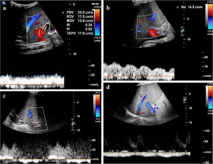 This set of four pediatric axial intercostal color Doppler and spectral ultrasound images demonstrates a spectrum of hepatic portal vein flow patterns associated with Sinusoidal Obstruction Syndrome (SOS). Panel (a) shows normal hepatopetal flow with typical velocity (PSV 23.0 cm/s) and a steady spectral waveform. Panel (b) illustrates increased pulsatility and decreased flow velocity (14.5 cm/s), reflecting rising sinusoidal resistance. Panel (c) displays a 'to-and-fro' pattern, where the spectral waveform alternates between positive and negative deflections, indicating bidirectional, stagnant flow. Panel (d) demonstrates hepatofugal flow, where blood moves away from the liver, appearing as blue signals on Doppler with an inverted spectral waveform below the baseline. These diagnostic images provide critical visual evidence of hemodynamic progression in SOS, ranging from early resistance to advanced portal hypertension and flow reversal. The content is intended for intermediate to advanced medical learners in radiology, hepatology, and pediatric oncology to assist in the classification and monitoring of vascular complications following hematopoietic stem cell transplantation.