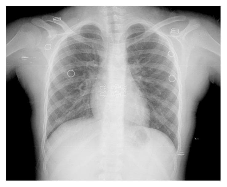 Anteroposterior (AP) chest radiograph of a pediatric patient demonstrating the 'steeple sign,' a diagnostic radiological finding characterized by symmetrical subglottic narrowing of the trachea. The narrowing produces an inverted 'V' or church steeple-like appearance of the airway column, indicative of subglottic edema or stenosis. The image displays the thoracic cage, including the ribs, clavicles, and vertebral column, with clear lung fields and a normal cardiomediastinal silhouette. Several external radiopaque markers and monitoring leads are visible overlying the chest wall and shoulder regions. The visual findings are consistent with conditions causing upper airway obstruction, such as laryngotracheobronchitis (croup) or subglottic stenosis as described in the clinical context of progressive dysphonia and respiratory insufficiency. This diagnostic image serves as a critical educational tool for identifying anatomical manifestations of upper airway narrowing in pediatric respiratory pathology.