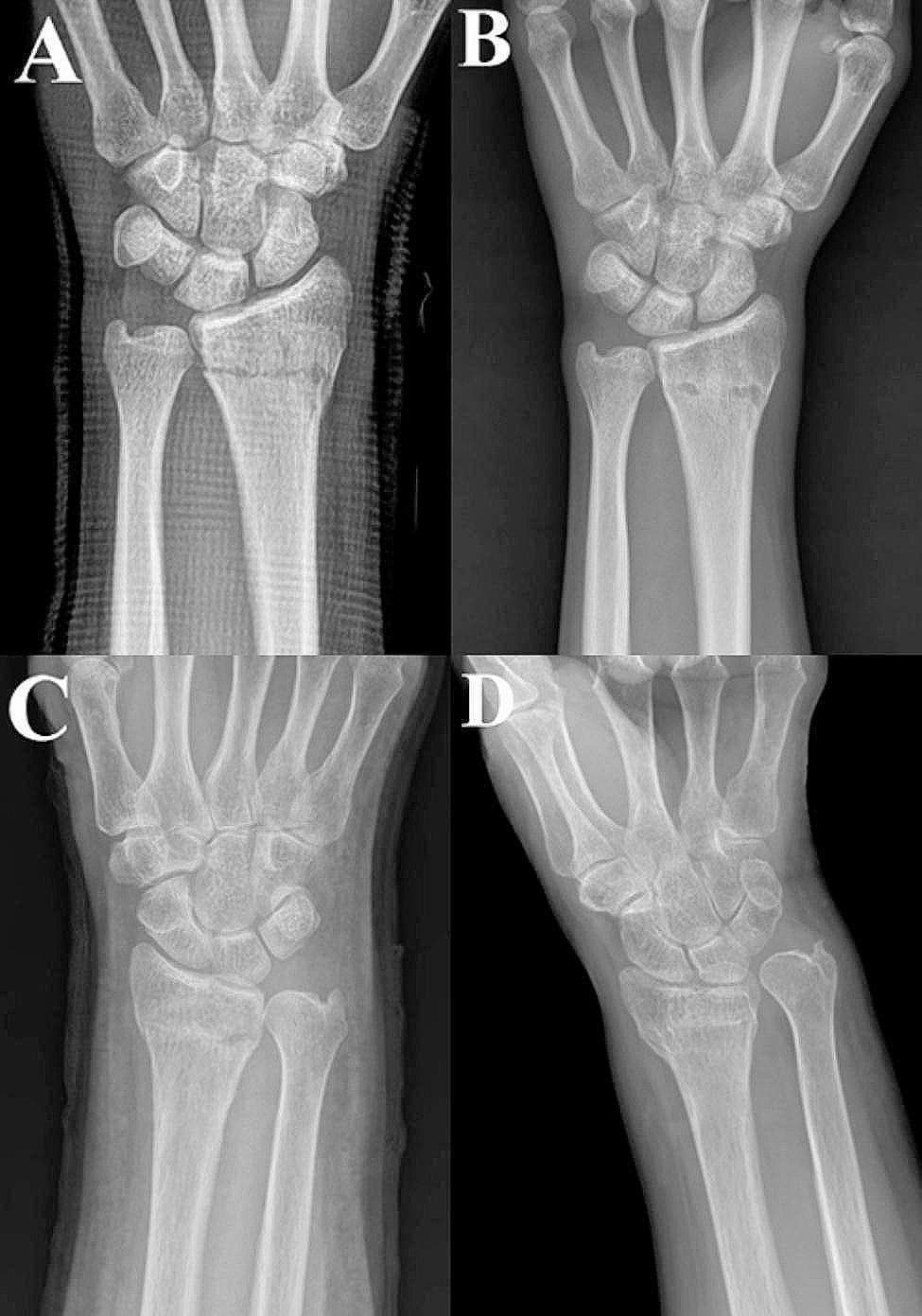 This diagnostic image consists of four anteroposterior (AP) x-ray radiographs of the wrist joint, categorized as comparison charts for orthopedic evaluation. Panels A and B demonstrate a successful radiological outcome. Panel A shows the wrist immediately following a closed reduction of a distal radius fracture, immobilized in a radiopaque Muenster splint; the distal radius and ulna exhibit anatomical alignment and neutral ulnar variance. Panel B shows the final follow-up of the same patient, revealing stable maintenance of the reduction and healed cortical surfaces. In contrast, panels C and D illustrate a poor radiological result. Panel C shows the immediate post-reduction state with acceptable initial alignment. However, panel D, the final follow-up, displays significant malunion characterized by radial shortening, increased positive ulnar variance, and dorsal/radial angulation of the distal radius fragment. This comparison highlights the potential for secondary displacement in distal radius fractures during conservative management with splinting. The series is intended for medical education on fracture management, radiological assessment of reduction quality (radial height and inclination), and monitoring for malunion.