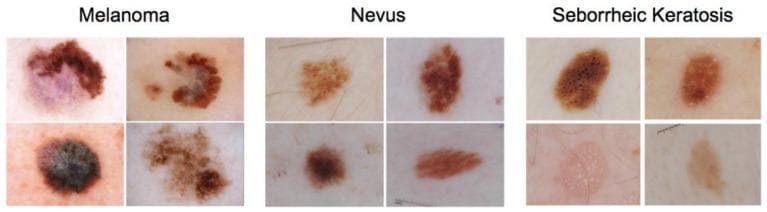 This Comparison Chart presents twelve dermoscopic images categorized into three distinct skin lesion types: Melanoma, Nevus, and Seborrheic Keratosis. The visual aid serves to highlight key diagnostic morphological features used in dermatology and oncology. The Melanoma images demonstrate high clinical concern, characterized by marked asymmetry, irregular or notched borders, and significant color variegation including shades of black, dark brown, and areas of blue-white veil or regression (purple-gray hues). In contrast, the Nevus (common mole) examples display more benign features: symmetry, regular borders, and homogeneous pigment distribution, typically in a single shade of brown. The Seborrheic Keratosis images illustrate classic diagnostic clues for benign epithelial tumors, such as milia-like cysts (small white/yellow spots), comedo-like openings (dark keratin plugs), and a characteristic waxy or 'stuck-on' appearance with a verrucous, scaly texture. This comparative display is essential for medical training in differential diagnosis, particularly in distinguishing between malignant melanoma and common benign mimics. The images originate from the ISIC 2017 dataset, often utilized in benchmarking computer-aided diagnostic algorithms for skin cancer detection.
