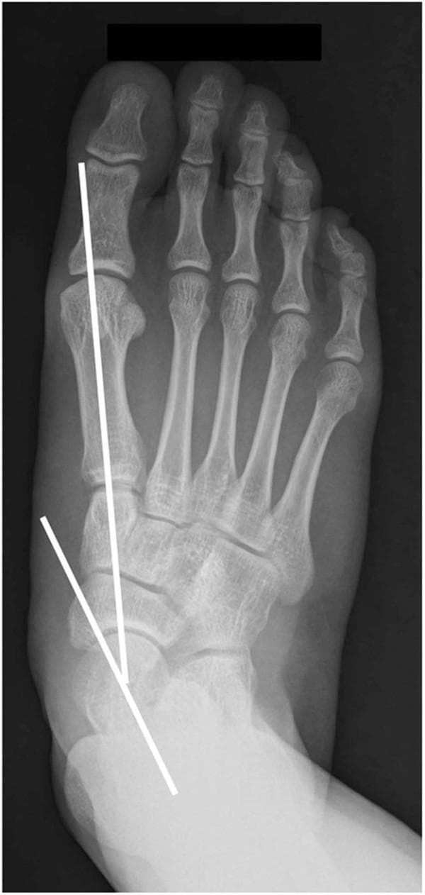 This diagnostic image is a weight-bearing anteroposterior (AP) radiograph of a human foot, illustrating key anatomical landmarks used in orthopedic assessment. The X-ray clearly visualizes the tarsal bones (talus, calcaneus, navicular, cuboid, and cuneiforms), the five metatarsals, and the phalanges. Superimposed on the anatomy are two white reference lines used to measure the Talo-first metatarsal angle. One line is drawn along the longitudinal axis of the talus, and the second line follows the longitudinal axis of the first metatarsal bone. The intersection of these lines demonstrates the angular relationship between the hindfoot and the forefoot. This measurement is clinically significant in evaluating foot deformities such as hallux valgus or pes planus. The radiograph demonstrates normal bone density and joint space preservation in the midfoot and forefoot regions, serving as an educational example of radiographic alignment and musculoskeletal geometry.
