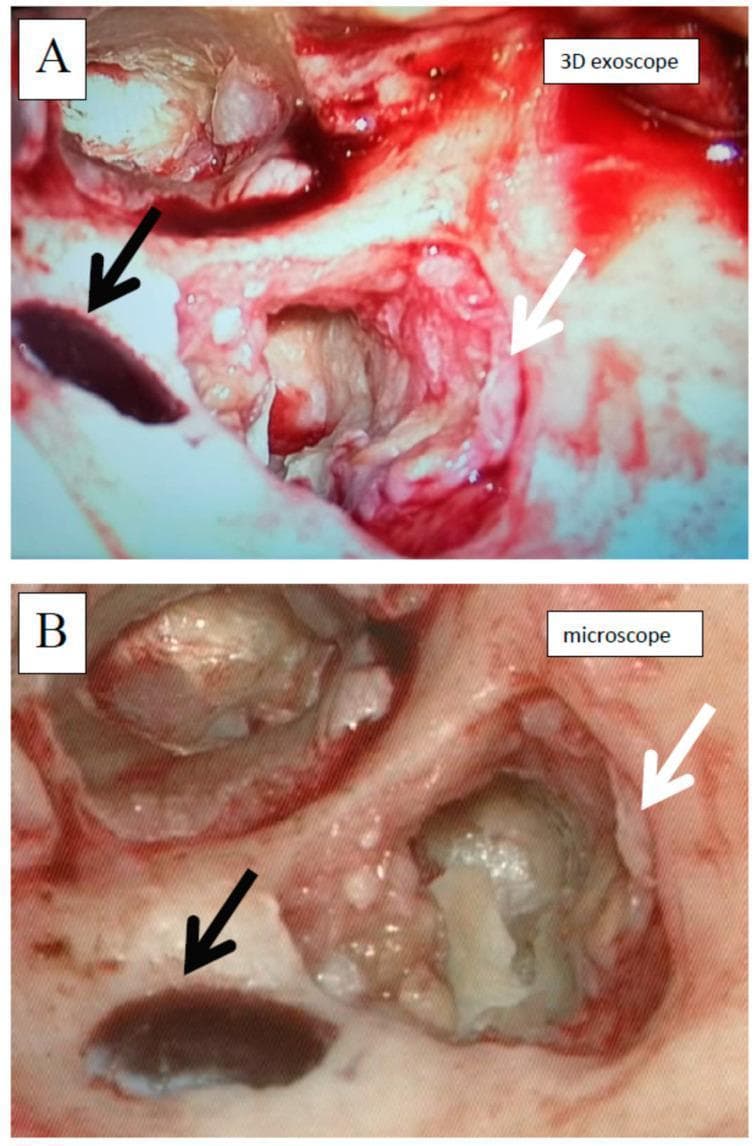 This medical comparison consists of two intraoperative images (A and B) showing the same surgical field during a cholesteatoma surgery in the left ear via a retroauricular approach. The images demonstrate an antromastoidectomy where the cholesteatoma has been partially removed. Image A is captured using a high-definition 3D exoscope, while Image B is captured using a standard operating microscope. In both images, a white arrow indicates the whitish, glistening cholesteatoma matrix, and a black arrow identifies the partially exposed sigmoid sinus, which appears as a dark, oval structure. The comparison highlights differences in visual perception between the two modalities: Image A shows more saturated red tones and a higher degree of visual interference from intraoperative bleeding, which appears to coat the tissue surfaces more intensely. Image B (microscope) exhibits a more natural, paler color palette with increased clarity of underlying bony structures and less perceived obscuration by blood. This serves as an educational comparison of visualization technologies in otolaryngology.