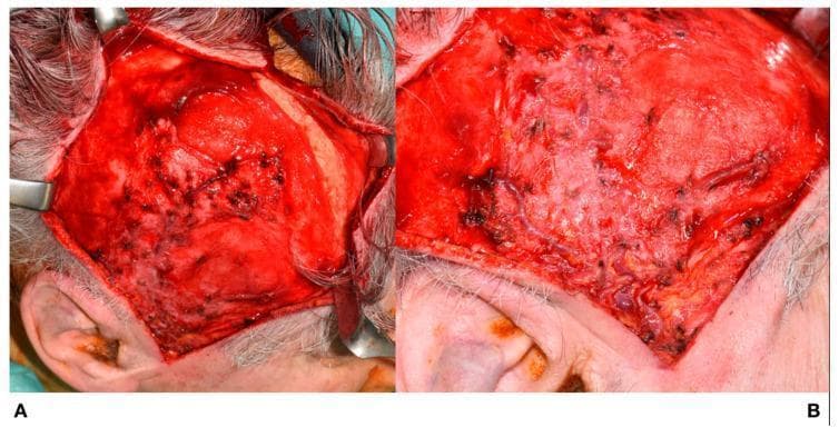 Clinical photograph of a coronal surgical approach for harvesting a galea-pericranium flap, shown in two intraoperative stages (A and B). The anatomical focus is the temporoparietal region of the scalp. Image A demonstrates the elevation of a skin flap using surgical retractors, revealing the underlying superficial temporal artery (STA) and superficial temporal vein (STV) preserved within the subcutaneous layer. The incision extends from the preauricular region superiorly. Image B shows the subsequent surgical step where the pericranium has been incised and blunt dissection is performed to detach it from the calvarium. The exposed surgical field displays increased vascularity and multiple hemostatic points following the separation of the pericranial layer from the bone. The images illustrate key steps in reconstructive surgery, specifically the preservation of the superficial temporal vascular supply for flap viability. The target audience includes surgical residents and specialists in oral and maxillofacial or plastic and reconstructive surgery.