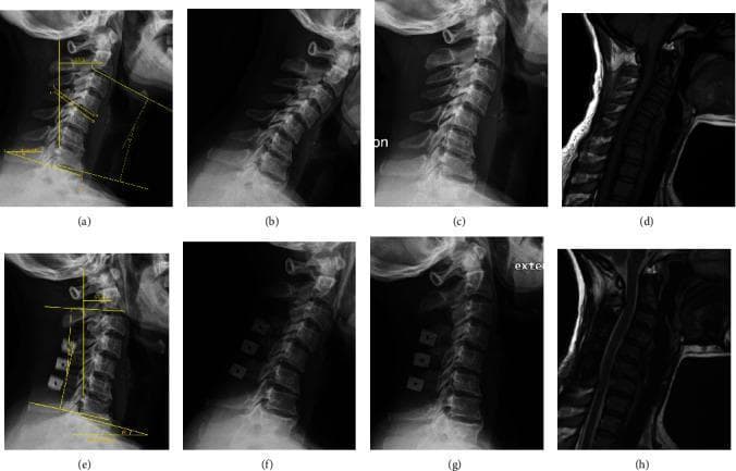 A comparative radiographic and MRI study of the cervical spine in a 42-year-old female patient with cervical spondylosis, highlighting pre-operative (a-d) and two-year post-operative (e-h) results. The pre-operative lateral X-ray (a) demonstrates a kyphotic alignment (Cobb angle ̑ = -13.3°) and measurement of T1 slope (β). Dynamic flexion (b) and extension (c) views assess the range of motion. The pre-operative sagittal MRI (d) shows baseline spinal cord compression. Post-operative lateral X-ray (e) following double-door laminoplasty shows improved cervical lordosis (̑1 = 10.6°) and the presence of radiopaque hydroxyapatite spacers within the expanded posterior elements. Post-operative dynamic X-rays (f, g) and sagittal MRI (h) illustrate preserved spinal stability and increased space for the spinal cord (decompression). Annotations on lateral views depict Cobb angles (C2-C7), T1 slope, and C2-C7 Sagittal Vertical Axis (SVA), providing quantitative metrics for surgical correction and sagittal balance.