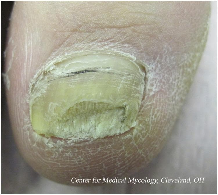 This clinical photograph shows a close-up view of a hallux (great toe) exhibiting classic features of distal subungual onychomycosis, a common fungal infection often caused by dermatophytes like Trichophyton rubrum. The nail plate demonstrates significant subungual hyperkeratosis, resulting in marked thickening and a crumbly, dystrophic texture at the distal edge. The nail is discolored with a yellowish-green hue and shows evidence of being trimmed to manage the bulk. A thin, horizontal dark line is visible near the proximal nail plate, possibly representing a splinter hemorrhage or subungual debris. The surrounding periungual skin displays secondary changes, including xerosis, scaling, and fine white fissuring, which may indicate concomitant tinea pedis or a compromised epidermal barrier. This image serves as a clinical example of chronic nail fungal infection, illustrating the diagnostic challenges posed by nail plate penetration and the necessity for long-term antifungal therapy.