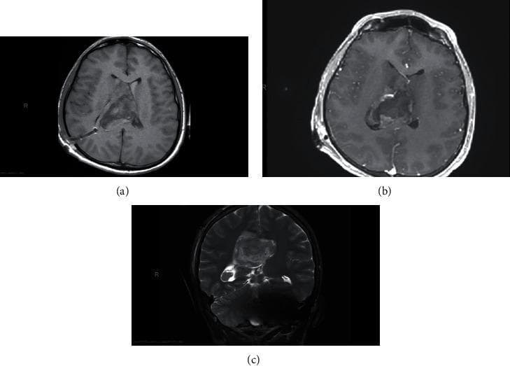 This diagnostic imaging panel displays MRI scans of the brain in axial (a, b) and coronal (c) planes. The images reveal a large, well-defined, and heterogeneous intraventricular mass centered in the right lateral ventricle, extending through the frontal horn and body. The mass exhibits significant mass effect, displacing the septum pellucidum across the midline toward the left and causing compression of the contralateral lateral ventricle. There is evidence of obstructive hydrocephalus, marked by the enlargement of the ventricular system. High-intensity signals in the dependent portions of the occipital horns and within the third and fourth ventricles on the T2-weighted coronal view (c) are consistent with intraventricular hemorrhage (IVH). The lesion demonstrates heterogeneous signal intensity with no gross contrast enhancement, which, in a young patient, is highly suggestive of a central neurocytoma. An external ventricular drain (EVD) or shunt component is partially visible in the right hemisphere in the axial views.