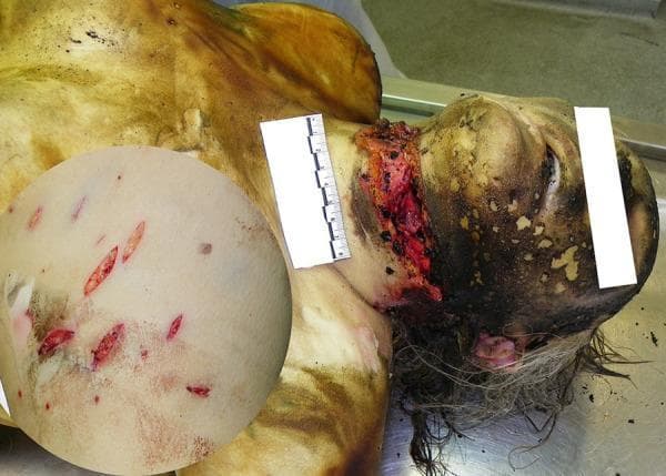 This forensic clinical photograph depicts the upper torso and head of a deceased individual with significant sharp force trauma and thermal injuries. A prominent, deep incised (slash) wound is visible across the anterior-lateral neck, demonstrating irregular edges and exposure of deep cervical structures including muscle and vascular tissue. A metric scale is placed adjacent to the neck wound for size reference. The head and face exhibit signs of thermal damage, including skin charring, soot deposition, and singed hair. An inset circular magnification on the left side of the image highlights the chest region, revealing multiple discrete, spindle-shaped (fusiform) stabbing-cutting injuries. These wounds are characterized by sharp margins and a linear distribution, consistent with a single-edged bladed instrument. The primary educational focus is the visual documentation of perimortem or postmortem trauma and thermal artifacts in a forensic pathology context, illustrating the morphological differences between large incised wounds and smaller stab wounds.