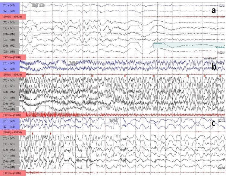 A polysomnographic (PSG) and electroencephalographic (EEG) recording displaying a sleep-hypermotor epilepsy (SHE) event, formerly known as nocturnal frontal lobe epilepsy. The content is presented in three chronological segments (a, b, and c) capturing a 30-second window. Segment (a) shows the ictal onset from N3 sleep, characterized by an abrupt transition from high-voltage slow-wave activity to rhythmic beta and theta frequencies. Segment (b) demonstrates the continuation of the event, where the EEG channels (F3-M2, F4-M1, C3-M2, C4-M1, O1-M2, O2-M1) exhibit high-amplitude, rapid, and sharp generalized epileptiform discharges, marked with red asterisks. These represent dense spikes and waves typical of frontal lobe seizures. Segment (c) captures the resolution of the event, with a gradual decrease in frequency and amplitude of discharges as the brain returns to a post-ictal state. The recording includes EOG (E1-M2, E2-M1), EMG (EMG1-EMG3), and EKG channels, providing a comprehensive view of the patient's physiological state during the seizure. This material is designed for advanced medical education in neurology and sleep medicine to illustrate EEG morphology during focal seizures.
