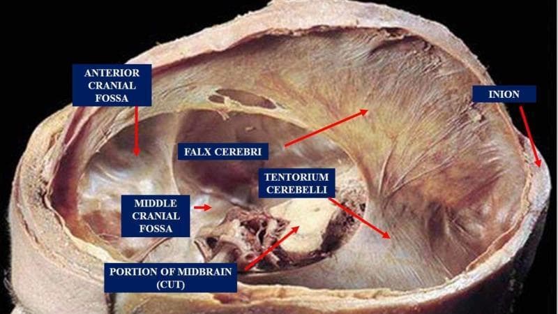 This clinical anatomical photograph displays a superior view of the internal cranial base and dural folds within a human cadaveric specimen. The image highlights the compartmentalization of the cranial cavity by the dura mater. Key structures identified include the falx cerebri, a vertical dural fold separating the cerebral hemispheres, and the tentorium cerebelli, a horizontal, semi-circular transverse septum that divides the occipital lobes from the cerebellum. The anatomical landmarks of the skull base are visible, specifically the anterior cranial fossa and the middle cranial fossa. A cross-section of the midbrain is shown passing through the tentorial notch. The posterior attachment point at the internal occipital protuberance, or inion, is also labeled. This visual serves as an educational tool for neuroanatomy and neurosurgery, illustrating the relationship between the dural membranes, the brainstem, and the bony fossae of the skull.