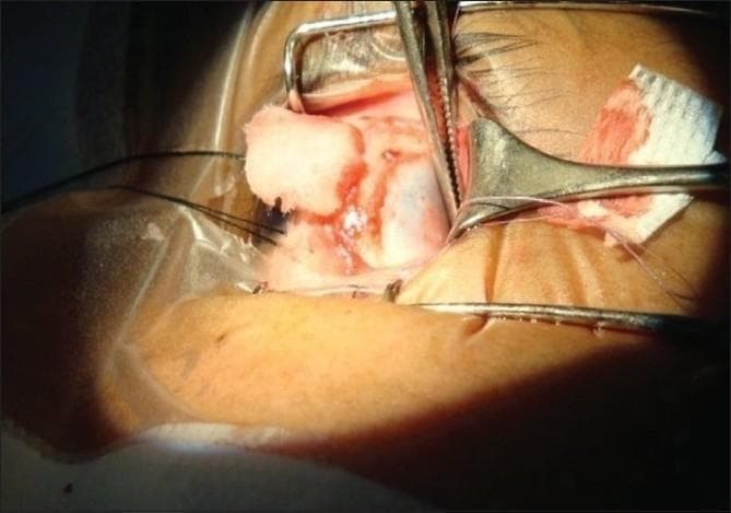 This clinical photograph captures a close-up, intraoperative view of an ophthalmic surgical procedure, specifically a strabismus surgery involving the extraocular muscle. The image demonstrates the application of pressure at the muscle-sclera interface following the use of iso-amyl cyanoacrylate (IAC) bioadhesive. The white scleral bed is clearly exposed, with the reddish extraocular muscle being held in apposition to the intended recession site. Key surgical instruments visible include a metallic speculum retracting the eyelids and forceps applying localized pressure to facilitate the adhesive 'take.' A blood-stained cellulose strip is used for drying the site, and fine, dark-colored sutures (6-0 Vicryl) are present, serving as backup traction or hang-back sutures. The photograph illustrates the surgical technique for sutureless muscle reattachment, focusing on the mechanical stabilization of the tissue-adhesive interface to ensure secure bonding before closure. This material is intended for educational use in ophthalmology and ophthalmic surgery training.