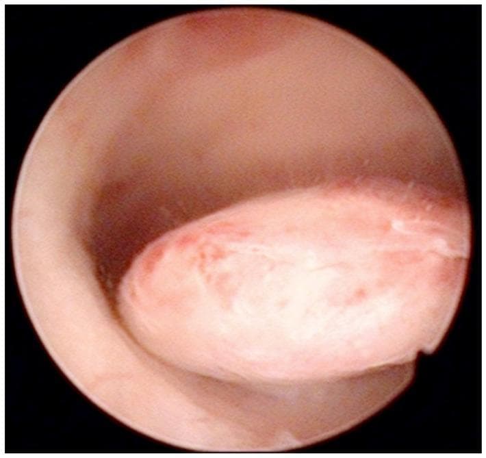 This diagnostic image is an intraoperative hysteroscopic photograph of the uterine cavity. The visual focus is a well-defined, oval-shaped pedunculated endometrial polyp protruding from the posterior uterine wall. The polyp demonstrates a smooth, glistening surface with a pale pink to white color, interspersed with focal areas of erythema and fine vertical striations across its body. Its morphology is slightly lobulated, and it is attached to the uterine wall by a distinct stalk. The surrounding endometrial tissue appears healthy, smooth, and pink, although there is a slight darkening near the base of the pedicle, likely representing minor blood accumulation. This clinical photograph illustrates a common structural cause of abnormal uterine bleeding (AUB), frequently categorized under the 'Polyp' component of the FIGO PALM-COEIN classification system. Such findings are critical in the diagnostic workup of perimenopausal and postmenopausal women to differentiate benign focal abnormalities from endometrial hyperplasia or malignancy.