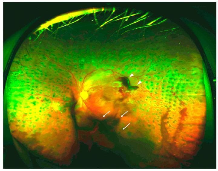This diagnostic image is an ultra-widefield fundus photograph of a human eye exhibiting signs of advanced Proliferative Diabetic Retinopathy (PDR). The image highlights critical secondary complications of retinal neovascularization. A localized, dense, dark-red preretinal hemorrhage (indicated by white arrowheads) is visible in the superior-temporal arcade, obscuring underlying retinal vessels. More inferiorly, diffuse and hazy vitreous hemorrhage (indicated by white arrows) appears as a larger, less-defined opacity within the vitreous cavity, partially masking the optic disc and central macula. The peripheral retina shows extensive panretinal photocoagulation (PRP) laser scars, appearing as a regular pattern of circular, hyperpigmented/hypopigmented spots. The presence of these active hemorrhages demonstrates vascular vulnerability and tractional forces typical of PDR, emphasizing the risk of significant vision loss. This visual is suitable for ophthalmology education focusing on diabetic eye disease and the differentiation between intraretinal, preretinal, and vitreous bleeding.