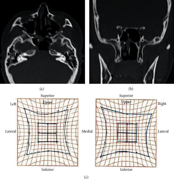 This composite medical image presents postoperative evaluations for a patient treated for a sphenoid sinus mucocele. (a) and (b) are non-contrast computed tomography (CT) images in axial and coronal planes, respectively. They demonstrate the paranasal cavity and skull base, showing a significant reduction in the size of the previously expansive sphenoid sinus mucocele following endoscopic decompression. The thinning of the surrounding bony structures, including the sella turcica and clivus area, is visible, reflecting the chronic pressure from the lesion. (c) displays a Hess screen test, a diagnostic clinical tool used to assess ocular motility and extraocular muscle function. The charts compare the field of vision and eye alignment for the left and right eyes. The results illustrate postoperative improvement in abduction disturbance, likely resulting from the decompression of the abducens nerve (CN VI) which was previously compromised by the mucocele's expansion toward the superior orbital fissure. This visual summary highlights the efficacy of surgical intervention in treating obstructive paranasal pathology and resolving secondary neurological deficits such as diplopia.