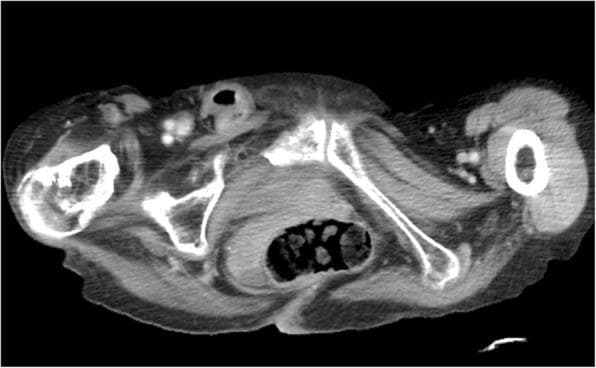 This diagnostic image is an axial contrast-enhanced Computed Tomography (CT) scan of the pelvic and upper femoral region. The primary finding is a right-sided strangulated femoral hernia, visualized as a herniated sac containing a loop of small intestine protruding through the femoral canal, medial to the femoral vessels. The incarcerated intestinal segment demonstrates wall enhancement, which is a critical finding suggesting preserved perfusion despite strangulation, though the loop appears distorted. Anatomical landmarks including the pelvic bones (pubis, ischium), femoral heads, and surrounding musculature provide orientation. The clinical significance of this imaging is to diagnose an incarcerated hernia and assess for secondary complications such as bowel ischemia or high-grade intestinal obstruction (ileus). This image is an essential educational resource for surgical residents and radiology students to identify the specific anatomical positioning of femoral versus inguinal hernias and to recognize signs of intestinal incarceration.