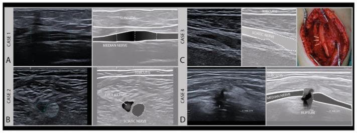 This composite educational graphic illustrates various degrees of axonal nerve damage using high-frequency musculoskeletal ultrasound (MSKUS) and intraoperative photography. The content is divided into four clinical cases, categorized by Sunderland's classification of nerve injury. Case 1 (A) shows a longitudinal US image of a median nerve demonstrating focal swelling and hypoechogenicity with intact fascicles (Sunderland Grade II). Case 2 (B) presents a transverse US image of a sciatic nerve (peroneal/fibular part) showing a heterogeneous, enlarged lesion. Case 3 (C) includes a longitudinal US and an intraoperative photograph showing severe sciatic nerve damage (Sunderland Grade III), where the intraoperative view confirms structural alterations corresponding to sonographic irregularities. Case 4 (D) displays a longitudinal US image of a median nerve featuring a complete loss of continuity and a visible rupture (Sunderland Grade V), typical of neurotmesis. Each case is accompanied by an anatomical schematic overlay identifying the subcutis and the specific nerve pathology. This resource is designed for intermediate to advanced medical learners focusing on neurology, radiology, and trauma surgery.