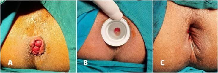 This clinical photograph sequence depicts three stages of a surgical hemorrhoidectomy for prolapsed internal hemorrhoids (Grade III/IV). Panel A shows the preoperative state with large, circumferential, erythematous hemorrhoidal piles protruding through the anal verge. The mucosa appears congested and edematous. Panel B demonstrates the intraoperative phase of anal dilatation. A white, circular, rigid plastic dilator is inserted into the anal canal to provide surgical exposure and reduce internal anal sphincter hypertonicity. A portion of the hemorrhoidal tissue is visible through the central aperture of the dilator. Panel C shows the immediate postoperative result following excision and radial wound closure. The protruding masses have been successfully resected. The anal canal is restored to its anatomical position with visible simple interrupted sutures (multifilament absorbable type) placed radially. Minor punctate bleeding is noted at the suture lines, which is typical for this stage of the procedure. The surrounding perianal skin remains intact and draped in a sterile surgical field.