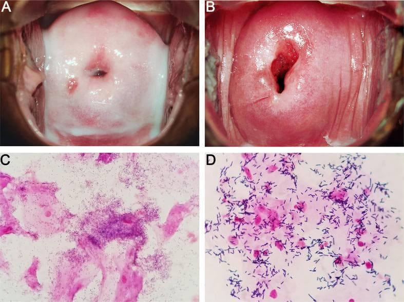 This four-panel image provides a side-by-side comparison of Bacterial Vaginosis (BV) and a normal vaginal microbiome through colposcopic and microscopic examinations. Panels A and B are colposcopic clinical photographs of the cervix and vaginal vault. Panel A (BV) displays characteristic thin, homogeneous, milk-white discharge coating the vaginal walls. In contrast, Panel B (Normal) shows a healthy cervix with clear, physiological secretions. Panels C and D show Gram-stained microscopic slides of vaginal smears. Panel C (BV) demonstrates the presence of 'clue cells'—vaginal epithelial cells heavily encrusted with coccobacilli (Gardnerella-like microbes) that obscure the cell margins. Panel D (Normal) shows a healthy microbiome dominated by large, purple-stained Gram-positive rods, consistent with Lactobacillus species, and clear epithelial cells without bacterial adherence. This comparison illustrates the clinical and laboratory findings used in Amsel criteria and Nugent scoring for the diagnosis of dysbiosis in the female reproductive tract.