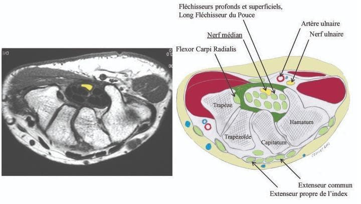 This medical visual consists of a side-by-side comparison between an axial magnetic resonance imaging (MRI) scan of the human wrist and a corresponding anatomical cross-section diagram. The image illustrates the anatomy of the carpal tunnel and surrounding structures. Key elements identified include the carpal bones (trapezium, trapezoid, capitate, and hamate) forming the floor and walls of the tunnel. Centrally located within the carpal tunnel, the median nerve is highlighted in yellow, positioned superficially to the deep and superficial flexor tendons and the long flexor tendon of the thumb. The flexor carpi radialis is shown in its distinct compartment. Outside the flexor retinaculum on the ulnar side, the ulnar artery and ulnar nerve are clearly demarcated. Posteriorly, the extensor tendons, including the extensor digitorum and extensor indicis, are visible. This educational material is designed to demonstrate the spatial relationship of the median nerve within the confined carpal space, which is clinically relevant for diagnosing and treating carpal tunnel syndrome.