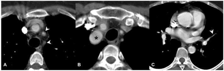 Diagnostic axial computed tomography (CT) scans of the chest in a patient with Takayasu arteritis, demonstrating large and medium-vessel vasculitis manifestations. Image A shows significant wall thickening and complete occlusion of the left common carotid and left subclavian arteries, indicated by white arrowheads, where contrast enhancement is absent within the lumen. Image B reveals aneurysmal dilation of the brachiocephalic trunk (marked with a black asterisk), characterized by an abnormal increase in vessel diameter. Image C illustrates involvement of the pulmonary circulation, specifically showing stenosis of a left pulmonary segmental artery (white arrowhead). This narrowing is attributed to granulomatous inflammation and subsequent fibrous thickening of the arterial wall. These images collectively highlight the diverse morphological changes—occlusion, dilation, and stenosis—typical of Takayasu arteritis, an idiopathic chronic inflammatory disease predominantly affecting the aorta and its primary branches.