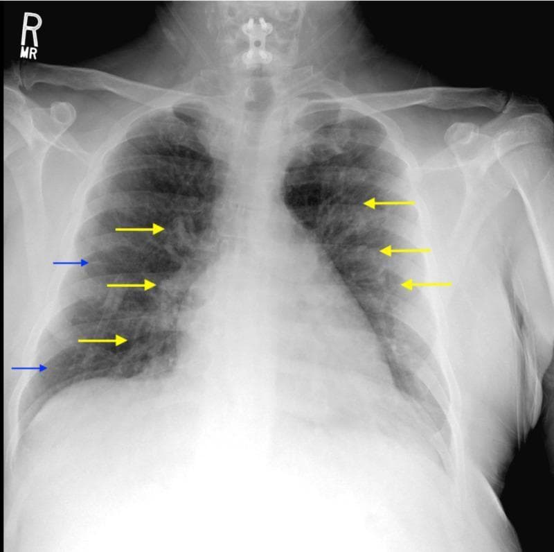 Anteroposterior (AP) chest X-ray demonstrating classic radiographic features of pulmonary interstitial edema and vascular congestion. The image shows a diffuse, bilateral increase in pulmonary opacification with a hazy 'bat-wing' distribution most prominent in the perihilar regions. Yellow arrows indicate perihilar vascular prominence and congestion, reflecting increased pulmonary venous pressure. Blue arrows highlight Kerley B linesβshort, horizontal, peripheral opacities located near the costophrenic anglesβwhich represent thickened interlobular septa due to fluid accumulation. The cardiac silhouette appears slightly enlarged, and the lung markings are obscured by the interstitial infiltrates. This diagnostic image is significant for teaching the clinical presentation of congestive heart failure or fluid overload in a medical setting, emphasizing the distinction between interstitial and alveolar patterns of edema.