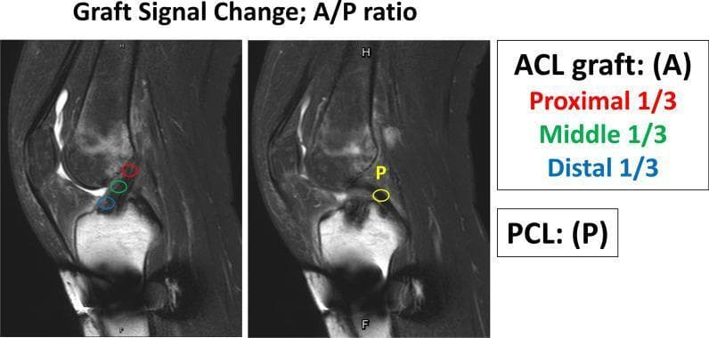 This diagnostic image displays two side-by-side sagittal T2-weighted MRI scans of a human knee joint, illustrating the methodology for assessing Anterior Cruciate Ligament (ACL) graft maturation. The images demonstrate the placement of Regions of Interest (ROIs) used to measure signal intensity. In the left panel, three circular ROIs are color-coded along the intra-articular course of the ACL graft: red for the proximal third (near the femoral tunnel), green for the middle third, and blue for the distal third (near the tibial tunnel). In the right panel, a yellow circular ROI labeled 'P' is placed on the mid-substance of the Posterior Cruciate Ligament (PCL), which serves as a hypointense reference point for signal normalization. The visual focuses on the 'A/P ratio'—a quantitative metric comparing graft signal (A) to the PCL signal (P)—to track ligamentization post-reconstruction. This clinical imaging tool is used in sports medicine and orthopedics to evaluate the biological healing of hamstring tendon grafts within the joint environment.