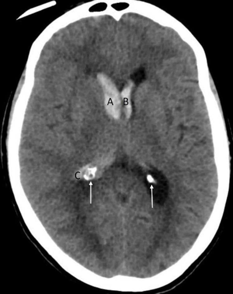 This diagnostic image is a non-contrast axial Computed Tomography (CT) scan of the brain, demonstrating the differentiation between acute intracranial hemorrhage and physiological calcification. The scan shows hyperdense areas within the lateral ventricles, labeled A and B, which represent intraventricular extension of an acute bleed. These areas exhibit high attenuation relative to the surrounding brain parenchyma and cerebrospinal fluid. In contrast, the regions marked with arrows, including area C, represent physiologic calcification of the choroid plexus. A key educational feature of this image is the density comparison: while the acute hemorrhage (A and B) is hyperdense, the choroid plexus calcification (C) is significantly more radiodense, with an attenuation profile paralleling that of the calvarium (skull bone). This comparison is critical for neuroradiological assessment of elderly patients presenting with potential stroke or traumatic brain injury. The image serves as an educational tool for identifying intraventricular hemorrhage and distinguishing it from common benign intracranial calcifications.