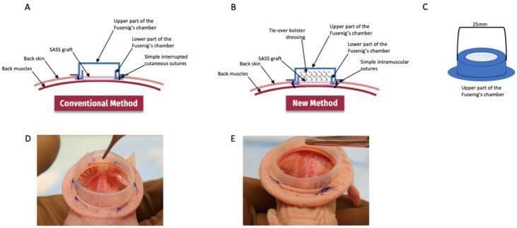 Educational medical composite comparing conventional and modified surgical techniques for securing a Fusenig's chamber in a skin graft animal model. (A) Schematic cross-section of the conventional method: a two-part silicon chamber (upper and lower) is secured to the back skin using simple interrupted cutaneous sutures, leaving the Self-Assembled Skin Substitute (SASS) graft exposed within the chamber. (B) Schematic of the new method: the chamber is fixed using intramuscular sutures that anchor the device deeper into the back muscles. A tie-over bolster dressing is added atop the SASS graft to promote adherence. (C) 3D diagram of the 25mm upper chamber cap. (D, E) Comparative intraoperative clinical photographs. (D) shows the conventional setup with visible cutaneous sutures and a less stable chamber positioning. (E) illustrates the modified technique where intramuscular stitches provide a more secure, flush fixation of the chamber to the wound bed, minimizing displacement and graft contraction. These visual elements demonstrate surgical refinements in tissue engineering to improve graft take and stability.