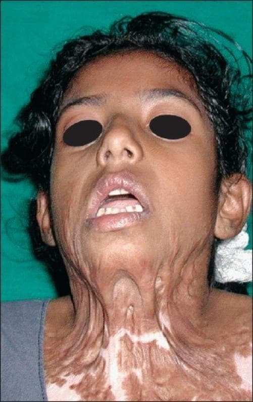 Clinical photograph of an 8-year-old female patient demonstrating a severe recurrent post-burn contracture of the neck. The image reveals extensive hypertrophic scarring extending from the lower face and perioral region down to the upper chest. Key findings include prominent longitudinal bands of scarred, thickened skin (cicatricial bands) that pull the chin toward the sternum, resulting in a distorted cervicomental angle and restricted neck extension. The skin exhibits significant dyspigmentation, characterized by a mosaic pattern of hyperpigmented dark brown patches and hypopigmented (depigmented) areas on the chest and neck. The lower lip appears slightly retracted due to the tension from the cervical contracture, and the normal anatomical contours of the neck are obliterated by tight, inelastic scar tissue. This case illustrates the functional and aesthetic impairment common in pediatric burn survivors with recurrent contractures following previous skin grafting.