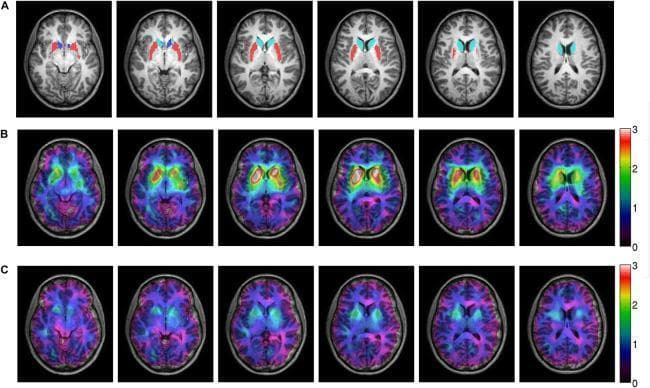 A comparison panel of axial diagnostic neuroimaging scans illustrating striatal dopamine D2 receptor occupancy during antipsychotic treatment. Panel A presents structural T1-weighted MRI slices with anatomical segmentations of the basal ganglia from the Harvard-Oxford atlas, highlighting the caudate nucleus (light blue), putamen (red), and nucleus accumbens (dark blue). Panels B and C display co-registered Single-Photon Emission Computed Tomography (SPECT) and MRI fusion images. The color heat map (scale 0–3) represents the specific binding potential of a radioactive tracer to dopamine D2 receptors. Row B shows baseline binding potential (pre-treatment) with high intensity (red/yellow) in the striatum. Row C depicts the same patient after six weeks of treatment with 300 mg of the antipsychotic amisulpride, demonstrating a visible reduction in tracer binding (blue/green shift), corresponding to a mean receptor occupancy of 56%. This visual illustrates the pharmacological mechanism of competitive receptor blockade in psychiatric neuroimaging.