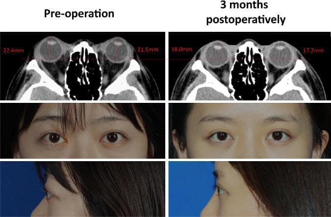 A comparison of pre-operative and 3-month post-operative clinical photographs and diagnostic imaging of a patient with thyroid eye disease (TED). The top row features axial CT scans of the orbits, demonstrating a significant reduction in orbital fat and proptosis; exophthalmos measurements decrease from 22.4 mm (right) and 21.5 mm (left) pre-operatively to 18.0 mm and 17.2 mm post-operatively. The middle row shows frontal clinical photographs, highlighting a notable improvement in upper eyelid retraction and a more natural eyelid position following surgical intervention. The bottom row displays lateral profile views, visually confirming the posterior displacement of the globes (reduction in proptosis) and decreased soft tissue volume in the periorbital and malar regions. This composite image serves to illustrate the anatomical and aesthetic outcomes of orbital fat decompression surgery, commonly managed within ophthalmology and oculoplastic surgery for Graves' ophthalmopathy.