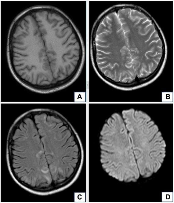 This diagnostic imaging set consists of four axial MRI brain scans (Panels A-D) demonstrating Posterior Reversible Encephalopathy Syndrome (PRES), also known as Reversible Posterior Leukoencephalopathy Syndrome (RPLS), in a 20-year-old female with preeclampsia. Panel A shows a T1-weighted image (T1WI) where bilateral parieto-occipital lesions appear isointense to hypointense. Panel B (T2-weighted) and Panel C (T2-FLAIR) reveal corresponding areas of marked hyperintensity, predominantly involving the subcortical white matter. Panel D (Diffusion-Weighted Imaging, DWI) demonstrates a lack of significant hyperintensity in these same regions, indicating the absence of restricted diffusion. This radiologic pattern—specifically the T2/FLAIR hyperintensity without DWI restriction—is characteristic of vasogenic edema rather than cytotoxic edema. The image serves as a clinical teaching tool for identifying the classic posterior distribution of edema in hypertensive emergencies or preeclampsia, emphasizing the utility of multi-sequence MRI in differentiating reversible vasogenic processes from irreversible infarction.